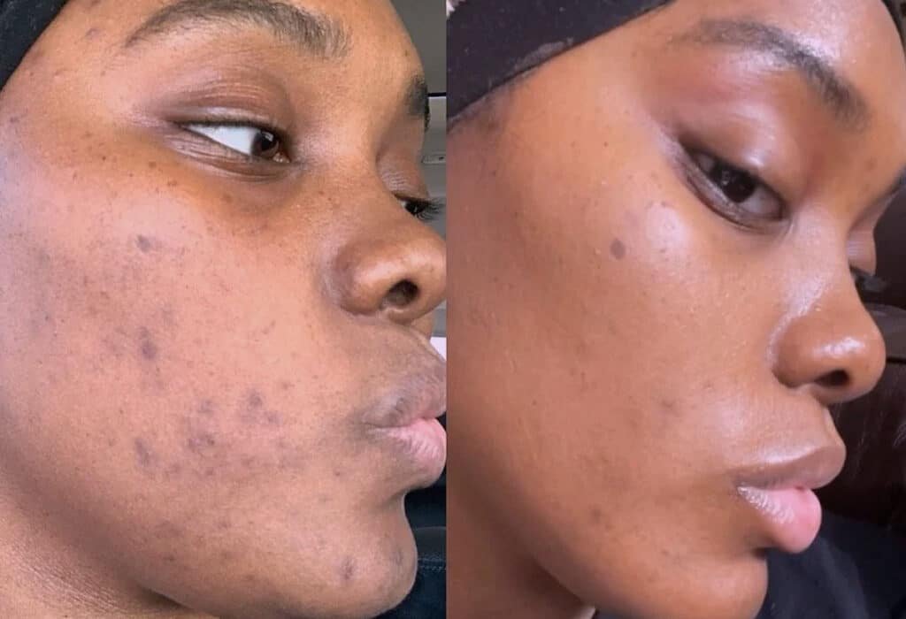 Niacinamida atua na redução da acne