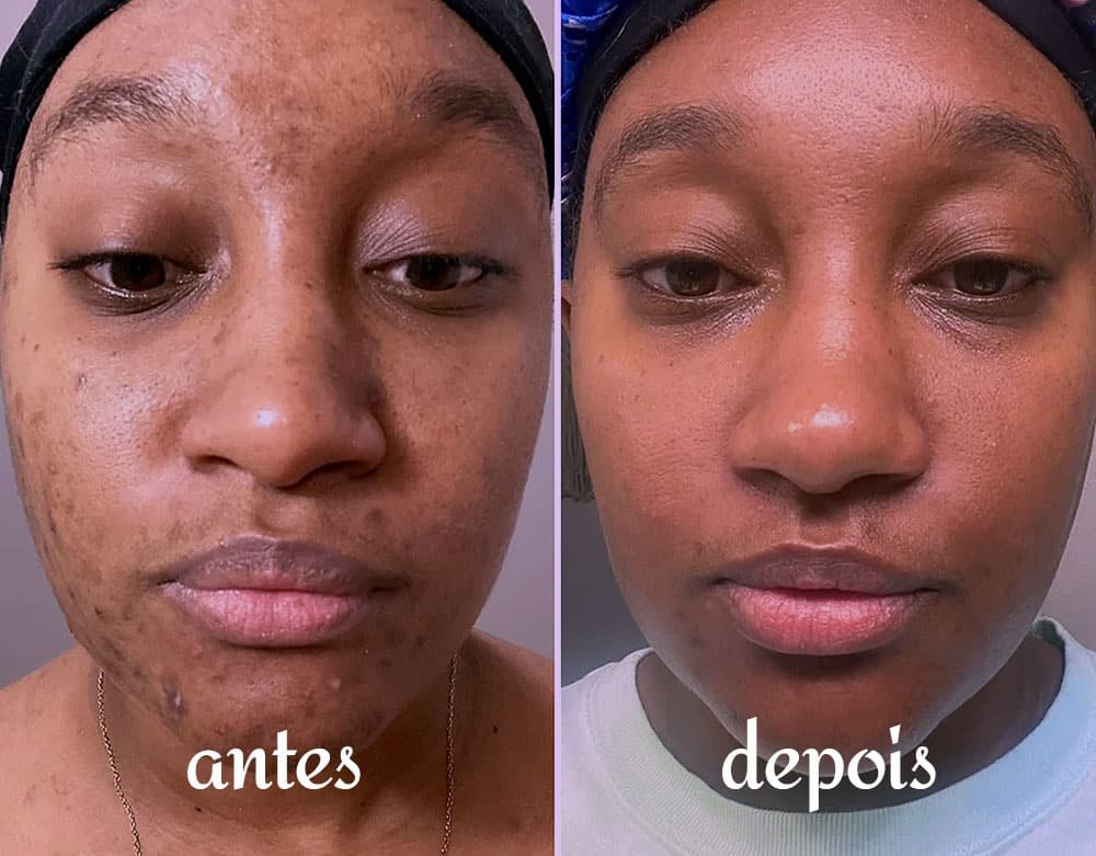 Redução de marcas de acne após uso de Retinol.